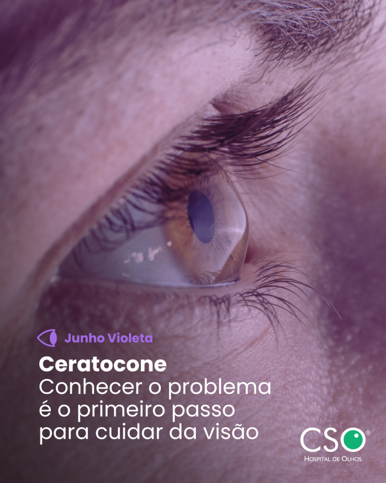 Ceratocone: conhecer o problema é o primeiro passo para cuidar da visão. Junho Violeta é o mês de conscientização sobre o ceratocone, uma condição que modifica a curvatura da córnea e pode comprometer seriamente a visão.