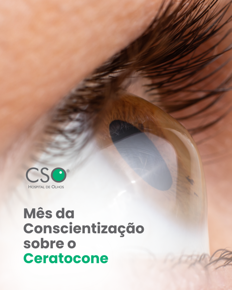 Agosto: Mês da Conscientização sobre o Ceratocone Agosto também é um mês importante para falarmos sobre o ceratocone, uma doença progressiva que afeta a córnea e pode comprometer a qualidade da visão.