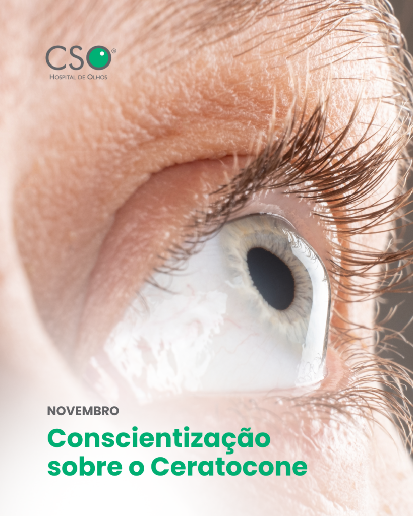 Dia Mundial do Ceratocone Dia 10 foi o Dia Mundial do Ceratocone, uma data dedicada à conscientização sobre uma das doenças oculares que mais afetam a córnea.