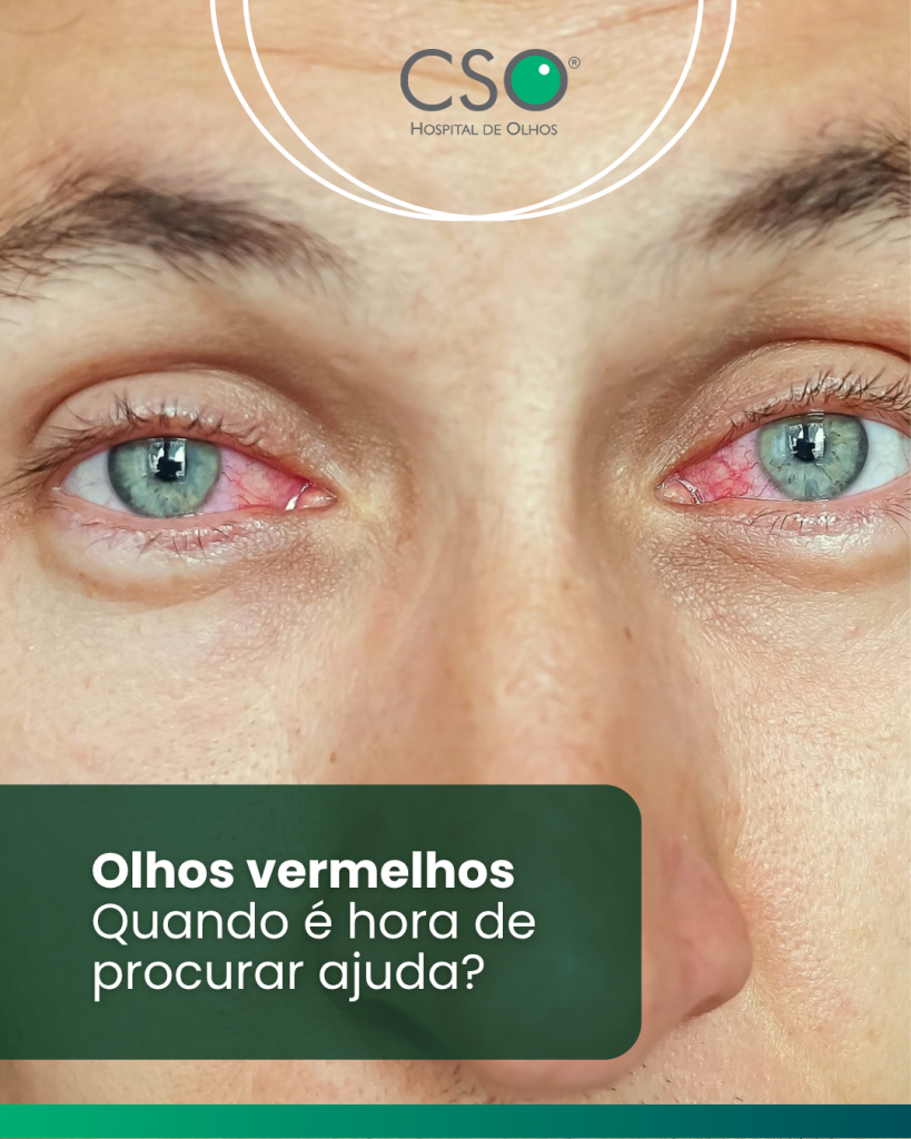 Olhos vermelhos: quando é hora de procurar ajuda? Vermelhidão nos olhos pode aparecer por diferentes motivos, como ressecamento, alergias, irritações ou infecções.